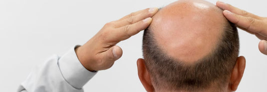 CBD-contra-la-Alopecia-beneficios-efectos-y-tratamiento Laboratorios Beemine