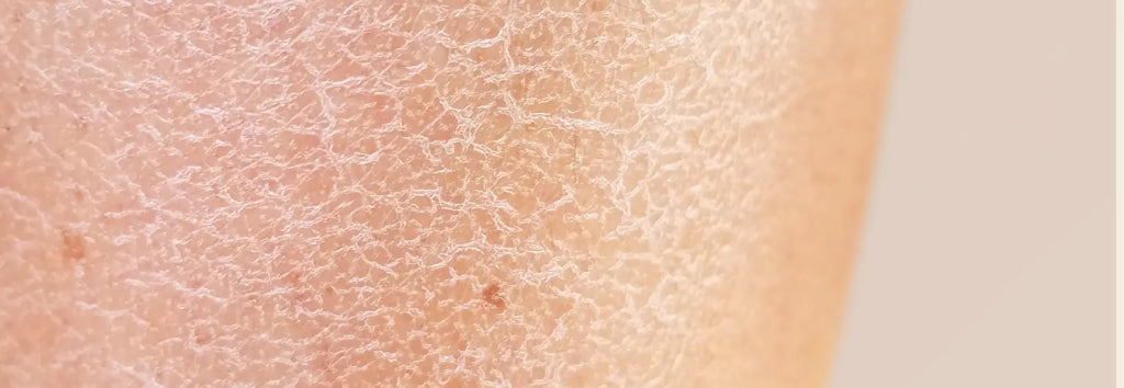 Cómo-combatir-la-piel-seca-con-CBD Laboratorios Beemine