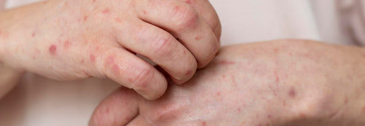 Por-qué-los-Cannabinoides-pueden-ayudar-a-la-psoriasis Laboratorios Beemine